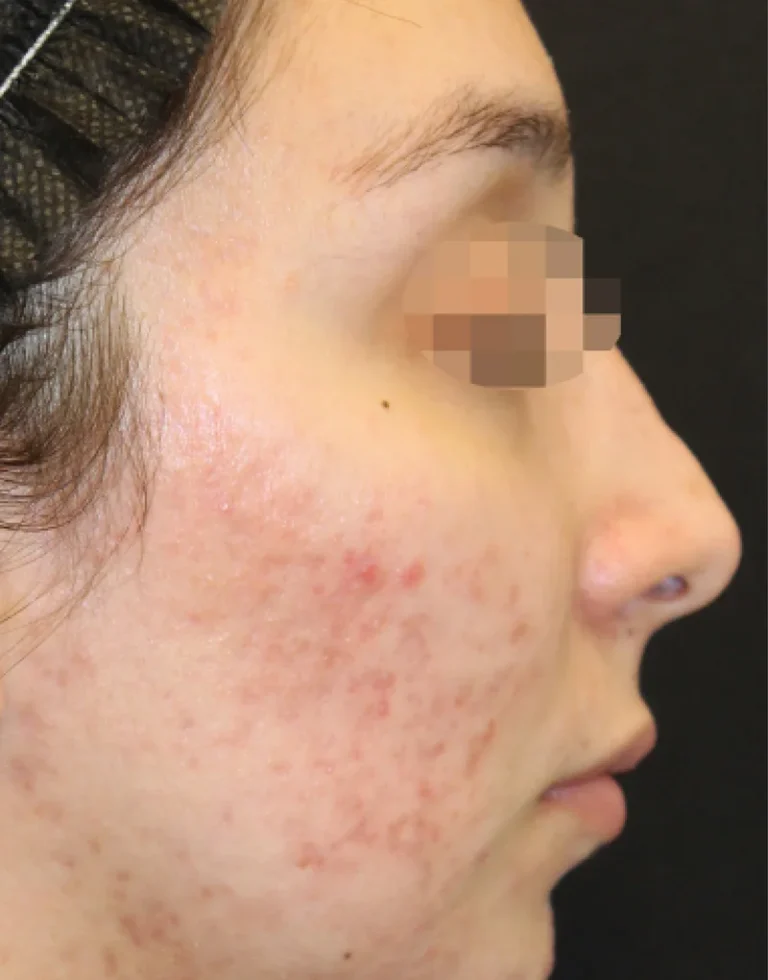 Acne Treatment