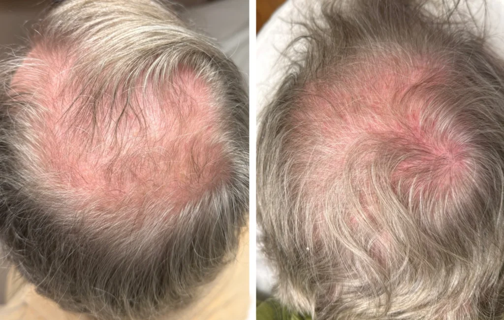 Laser Hair Restoration, Dallas Facial Laser, Laser Hair Removal, Laser Hair Restoration and Facial Services.