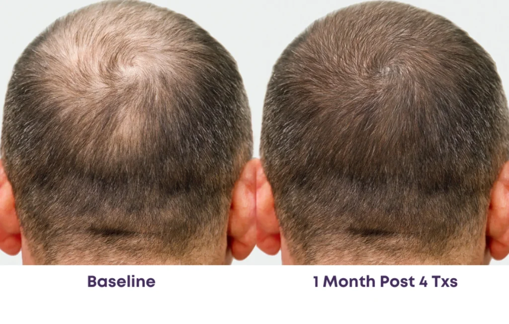 Laser Hair Restoration, Dallas Facial Laser, Laser Hair Removal, Laser Hair Restoration and Facial Services.