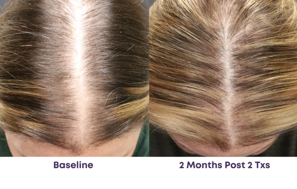 Laser Hair Restoration with ALMA TED Before and After