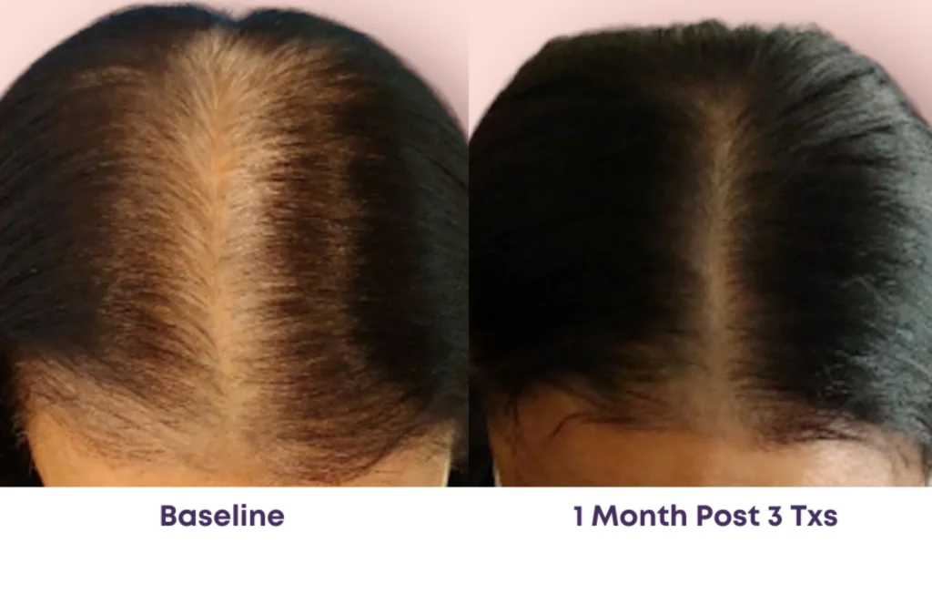 Laser Hair Restoration, Dallas Facial Laser, Laser Hair Removal, Laser Hair Restoration and Facial Services.