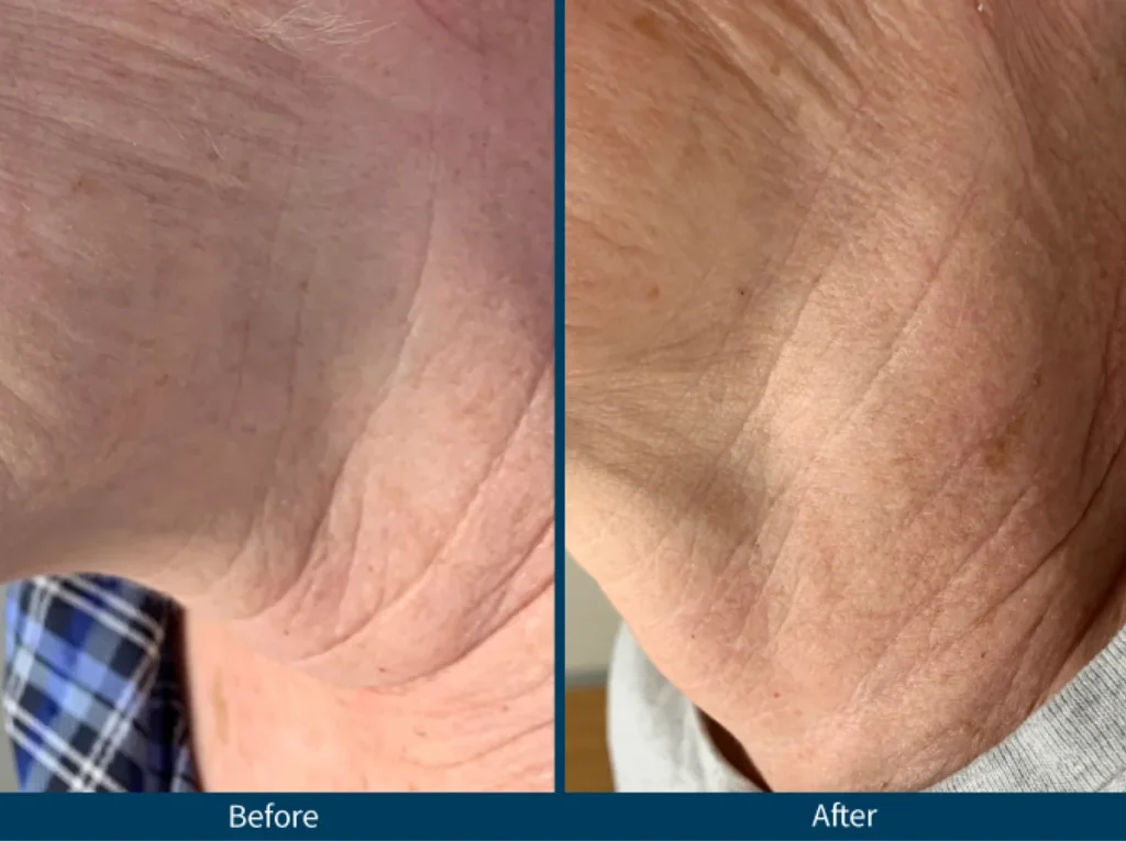 Micro Needling SkinPen