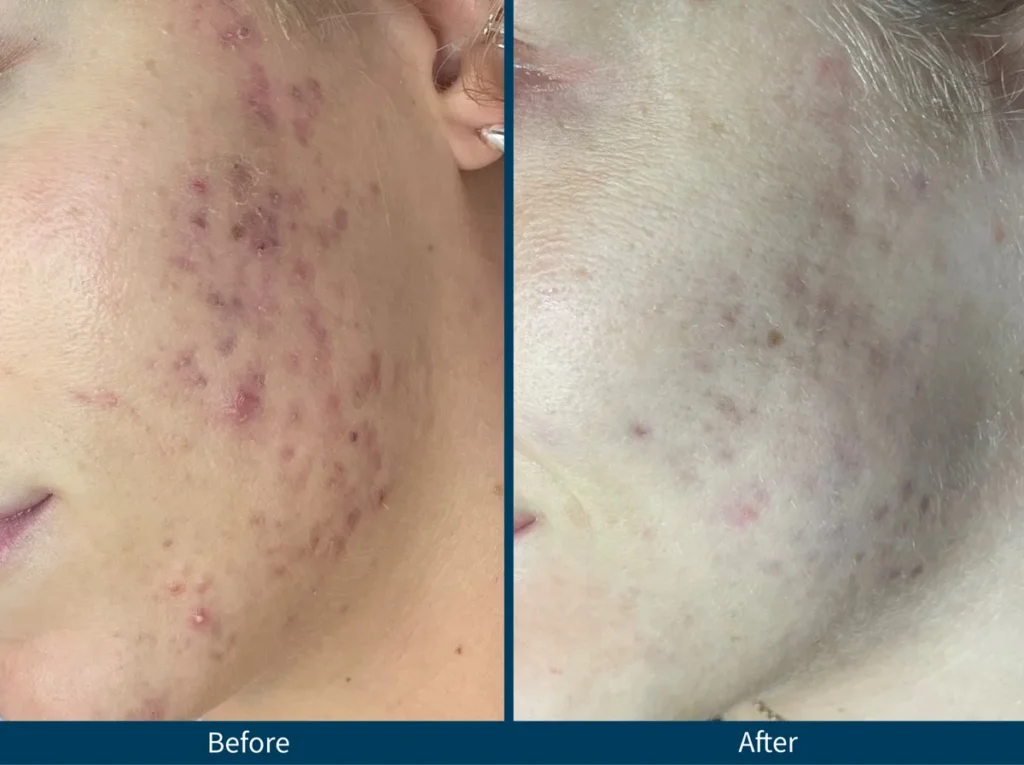 Micro Needling SkinPen