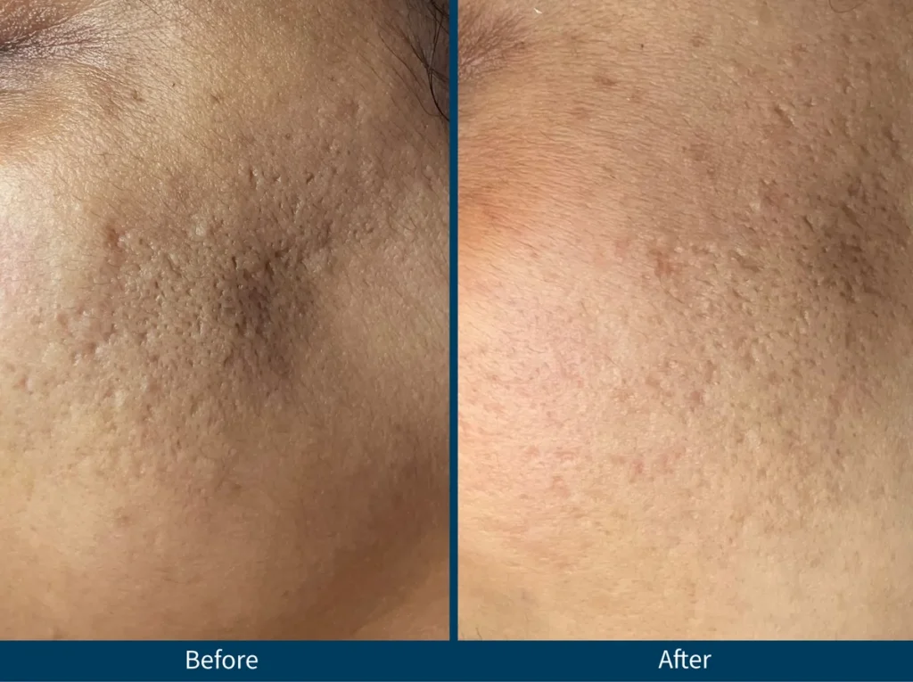 Micro Needling SkinPen