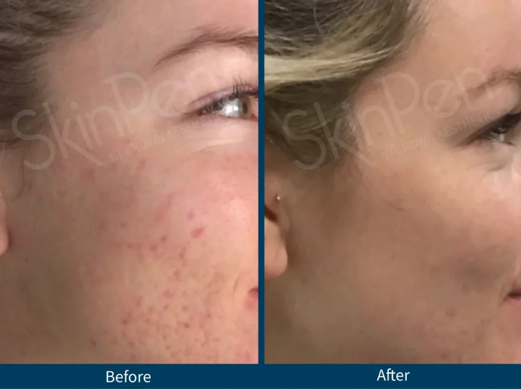 Micro Needling SkinPen