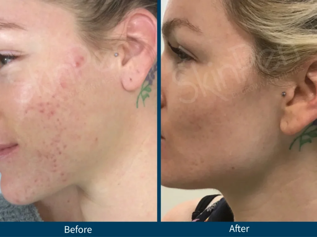Micro Needling SkinPen