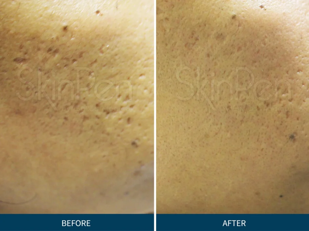 Micro Needling SkinPen