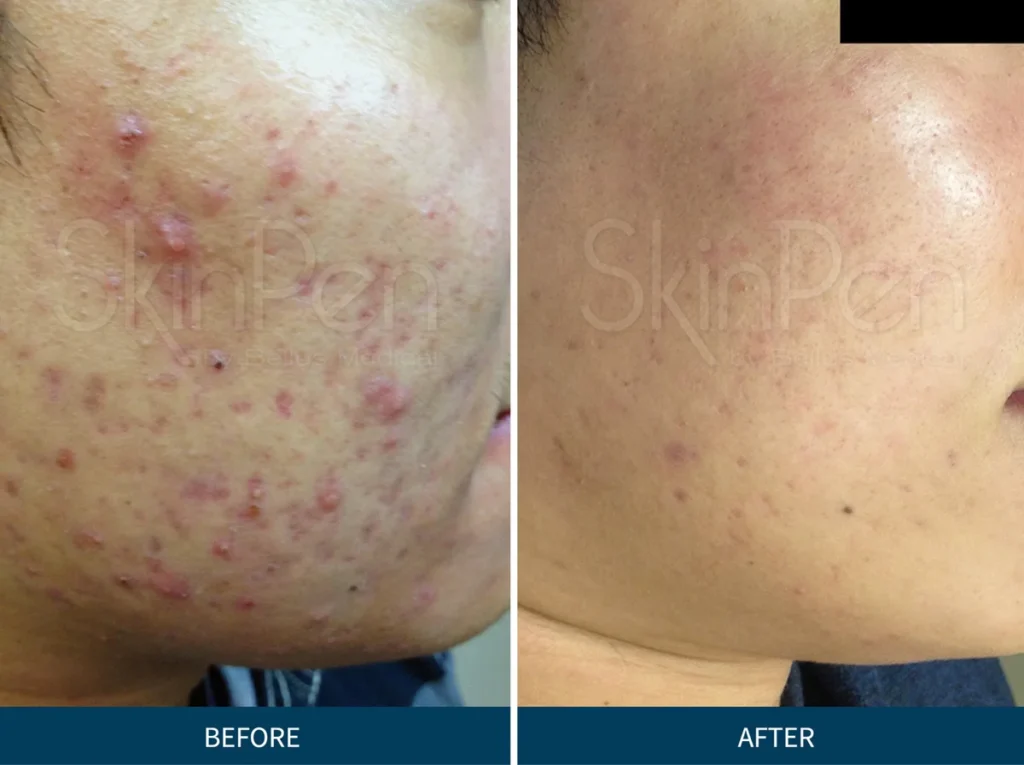 Micro Needling SkinPen