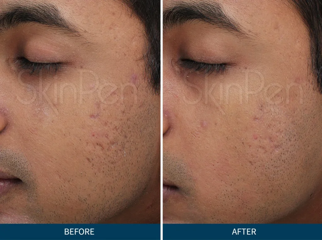 Micro Needling SkinPen