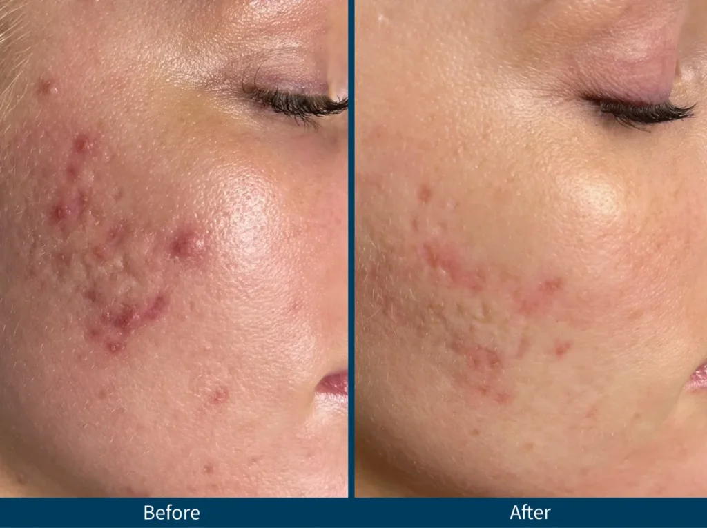 Micro Needling SkinPen