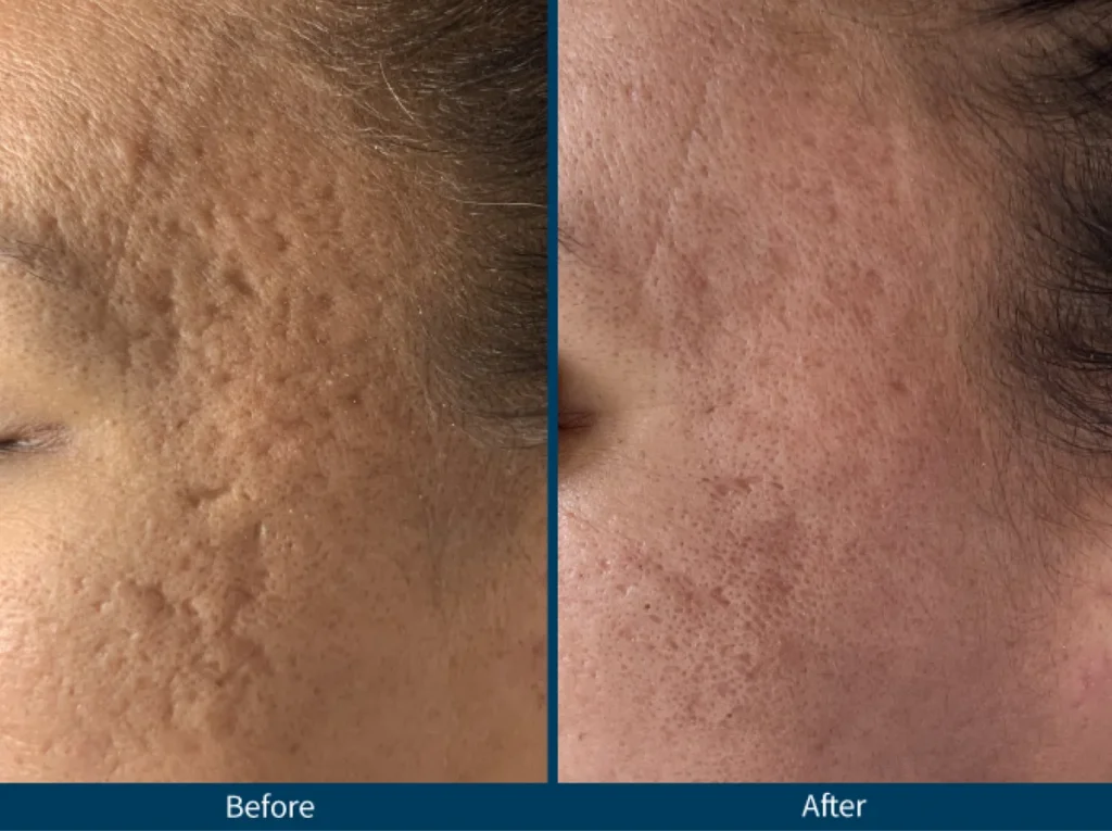 Micro Needling SkinPen