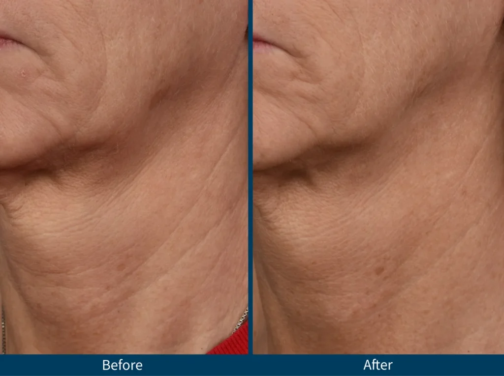 Micro Needling SkinPen
