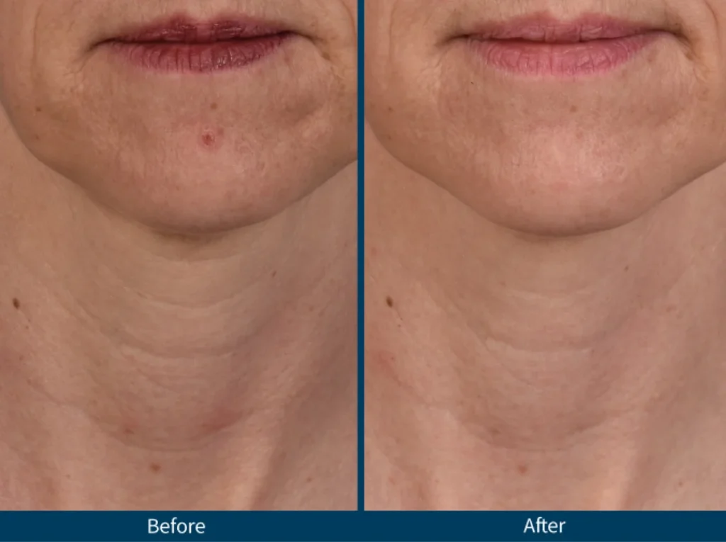 Micro Needling SkinPen